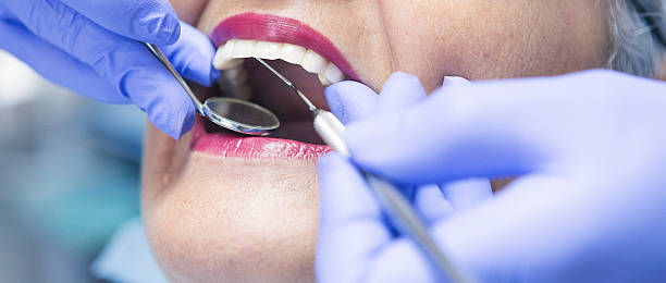 Best Emergency Wisdom Tooth Extraction in Bexley, OH